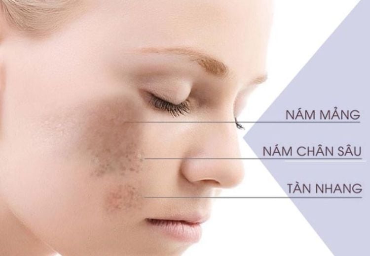 Nám nội tiết