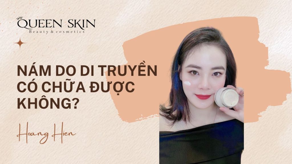 Nám do di truyền có chữa được không