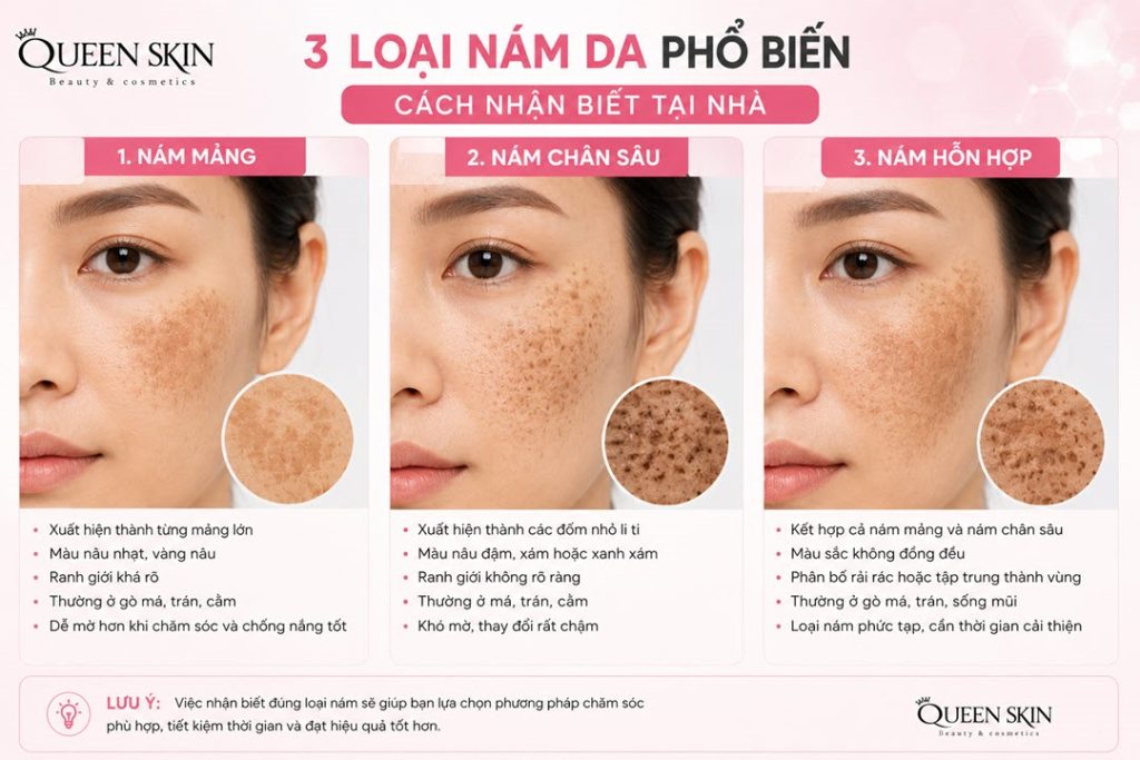 Các loại nám da phổ biến | Làm sao biết mình bị loại nám nào